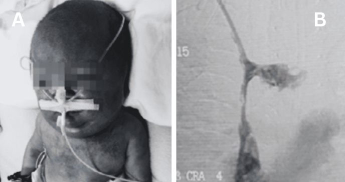 Neonato presentó síndrome de vena cava superior por trombosis tras 90 días de catéter venoso central