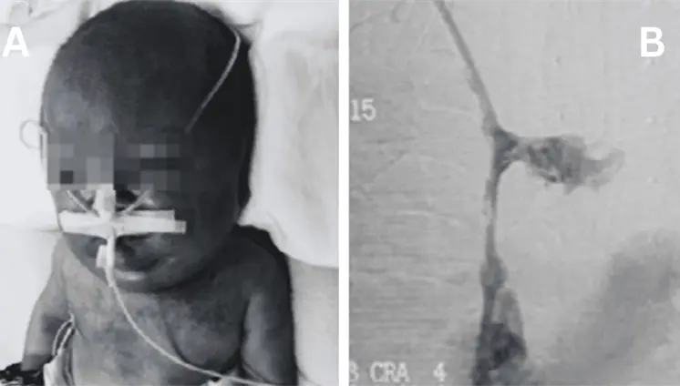 Neonato present&oacute; s&iacute;ndrome de vena cava superior por trombosis tras 90 d&iacute;as de cat&eacute;ter venoso central