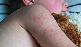 Sarampión se propaga rápidamente en EE.UU.:Se reportan brotes en 9 estados y más de 150 casos en Texas