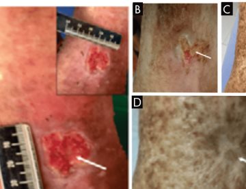 Tratamiento de colágeno tipo I logró cerrar úlceras venosas en 4 y 16 semanas, sin recidiva en 8 meses