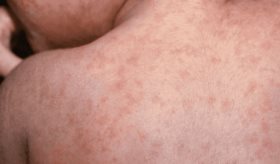 Disminuye la inmunización infantil y aumentan casos de sarampión: podrían reaparecer otras enfermedades