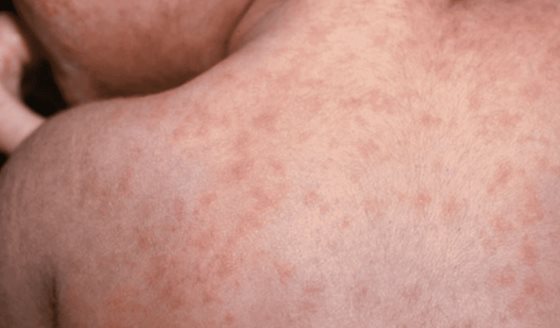 Disminuye la inmunización infantil y aumentan casos de sarampión: podrían reaparecer otras enfermedades