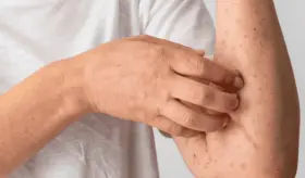 Alerta por sarampión en EE. UU.: Primer caso en Miami-Dade, Florida afecta a un estudiante de secundaria