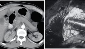 Describen caso de pancreatitis traumática por impacto directo en el hipocondrio derecho