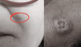 Mujer de 26 años y su mascota sufren envenenamiento por mordedura araña: manejo del estetodismo