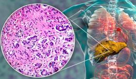 Descubren una nueva terapia llamada YAQ-005 para tratar la cirrosis y la insuficiencia hepática aguda