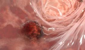 Revelan preocupante aumento de cáncer colorrectal en jóvenes puertorriqueños