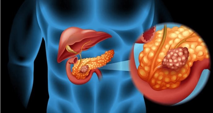 Descubren que el ADN extracromosómico es un factor clave en la agresividad del cáncer de páncreas