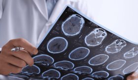 Herramienta de IA MELD Graph podría detectar el 64 % de las displasias corticales focales en epilepsia