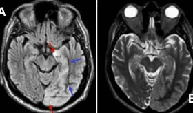 Paciente de 68 años presentó crisis epilépticas inducidas por complicación de diabetes mellitus tipo 2