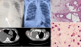 Disnea y distensión abdominal en mujer joven: endometriosis torácica con afectación pulmonar
