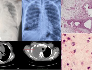 Disnea y distensión abdominal en mujer joven: endometriosis torácica con afectación pulmonar
