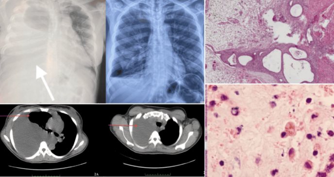 Disnea y distensión abdominal en mujer joven: endometriosis torácica con afectación pulmonar