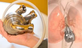 Hito en medicina: Hombre sobrevive 100 días con un corazón artificial mientras espera un trasplante