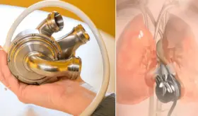 Hito en medicina: Hombre sobrevive 100 días con un corazón artificial mientras espera un trasplante