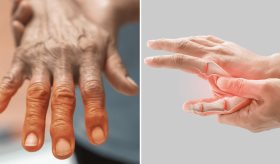 Depresión y ansiedad reducen la probabilidad de remisión en artritis reumatoide y artritis psoriásica