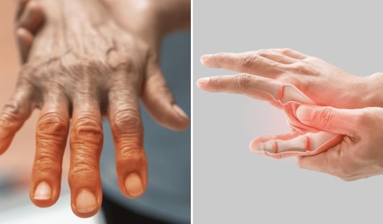 Depresión y ansiedad reducen la probabilidad de remisión en artritis reumatoide y artritis psoriásica