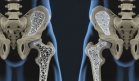 Científicos logran tratar la osteoporosis con terapia regenerativa que evita trasplantes celulares