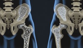 Científicos logran tratar la osteoporosis con terapia regenerativa que evita trasplantes celulares