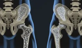 Científicos logran tratar la osteoporosis con terapia regenerativa que evita trasplantes celulares