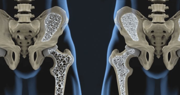 Científicos logran tratar la osteoporosis con terapia regenerativa que evita trasplantes celulares