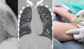 Mujer descubre años después que su implante anticonceptivo migró por torrente sanguíneo hasta su pulmón