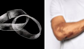 Hidrogel con autocuración que imita la piel humana: La clave para heridas crónicas y prótesis