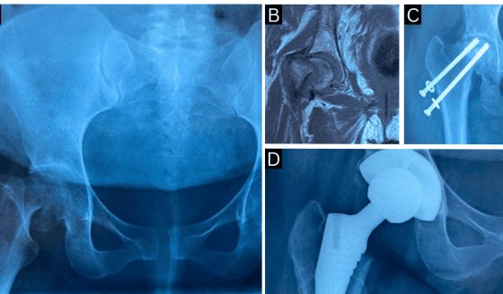 Primigesta presenta necrosis avascular bilateral de cadera con fractura subcapital por trabajo de parto