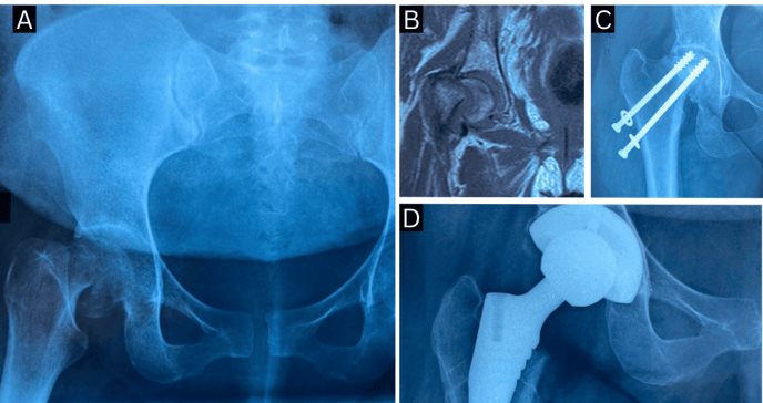 Primigesta presenta necrosis avascular bilateral de cadera con fractura subcapital por trabajo de parto