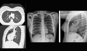 Aire bajo la piel y sibilancias: diagnóstico de neumomediastino en una paciente con crisis asmática