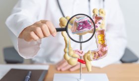 Estudio encuentra que la diverticulosis no está asociada con dolor abdominal ni cambios intestinales