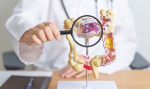 Estudio encuentra que la diverticulosis no está asociada con dolor abdominal ni cambios intestinales