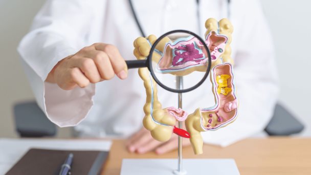 Estudio encuentra que la diverticulosis no está asociada con dolor abdominal ni cambios intestinales Estudio encuentra que la diverticulosis no está asociada con dolor abdominal ni cambios intestinales