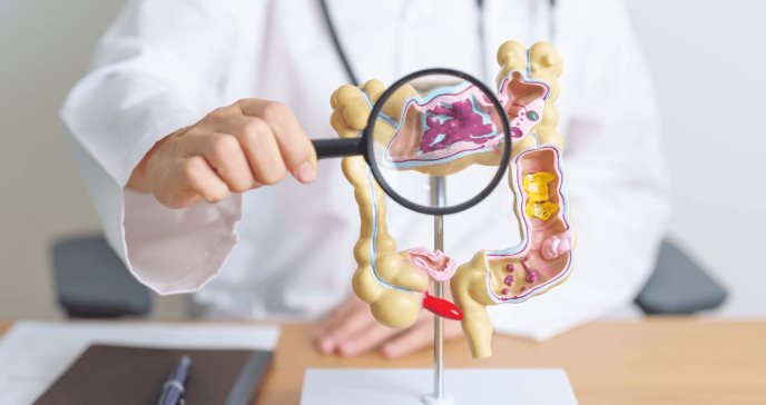 Estudio encuentra que la diverticulosis no está asociada con dolor abdominal ni cambios intestinales