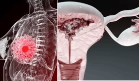 Los 5 cánceres más frecuentes en la mujer y su impacto en la salud  