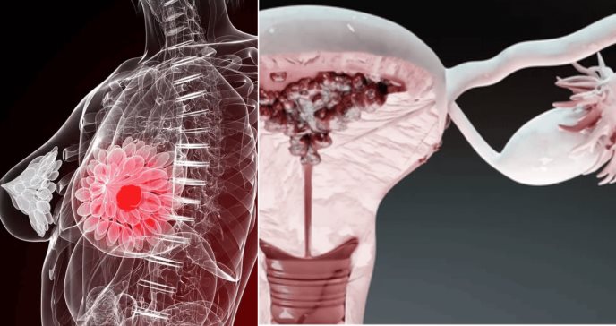 Los 5 cánceres más frecuentes en la mujer y su impacto en la salud  