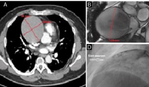 Hombre de 40 años presenta aneurisma gigante de arteria coronaria derecha asociado a consumo de drogas