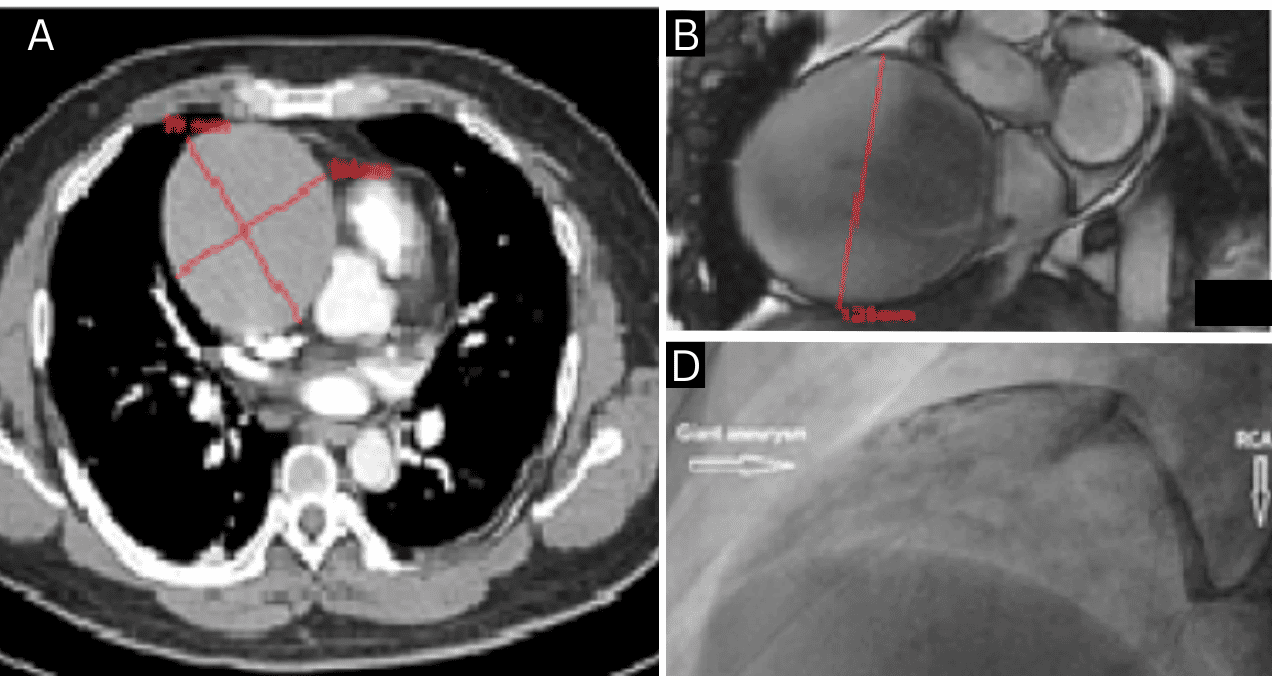 Hombre de 40 años presenta aneurisma gigante de arteria coronaria derecha asociado a consumo de drogas