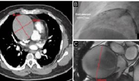 Hombre de 40 años presenta aneurisma gigante de arteria coronaria derecha asociado a consumo de drogas