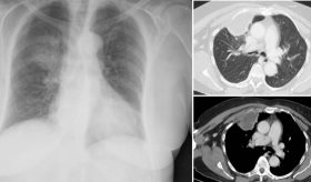 Paciente presenta dolor torácico y absceso por costocondritis séptica asociada a Staphylococcus aureus