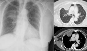 Paciente presenta dolor torácico y absceso por costocondritis séptica asociada a Staphylococcus aureus