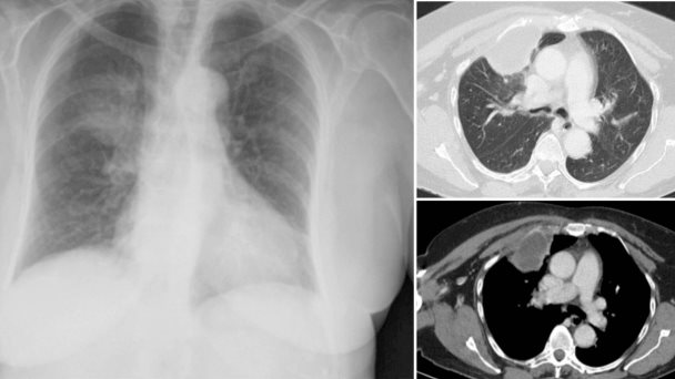 Paciente presenta dolor torácico y absceso por costocondritis séptica asociada a Staphylococcus aureus Paciente presenta dolor torácico y absceso por costocondritis séptica asociada a Staphylococcus aureus