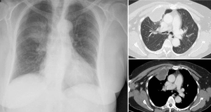 Paciente presenta dolor torácico y absceso por costocondritis séptica asociada a Staphylococcus aureus