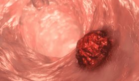 Cuatro síntomas clave del cáncer de colon en personas menores de 50 años  
