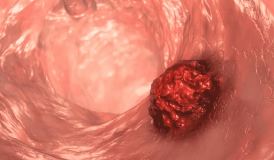 Cuatro síntomas clave del cáncer de colon en personas menores de 50 años  
