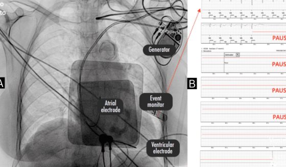 Caídas recurrentes en paciente de 87 años revelaron pausas sinusales prolongadas como causa subyacente