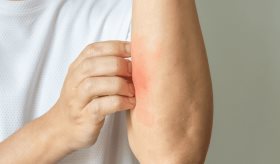 Recomendaciones actualizadas para el manejo de dermatitis atópica desde la atención primaria