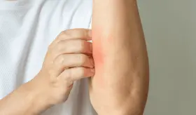 Recomendaciones actualizadas para el manejo de dermatitis atópica desde la atención primaria