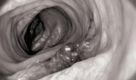 ¿Qué causa el cáncer colorrectal? Edad, genética, obesidad y  otros factores 