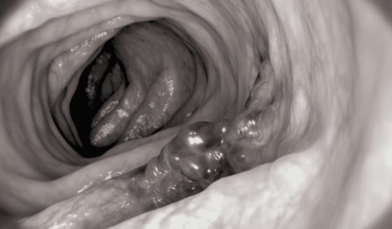 ¿Qué causa el cáncer colorrectal? Edad, genética, obesidad y  otros factores 